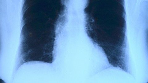 Lungröntgen